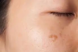 Como quitar las manchas solares en la piel – cuidado de la piel